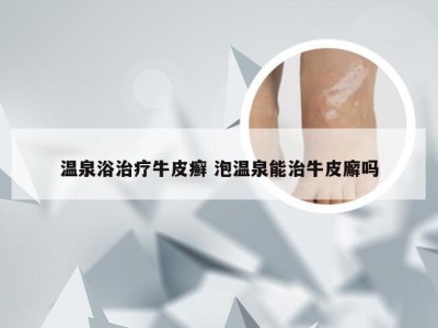 温泉浴治疗牛皮癣 泡温泉能治牛皮廨吗