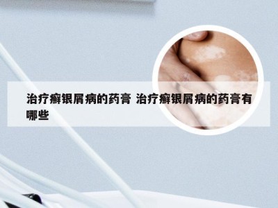 治疗癣银屑病的药膏 治疗癣银屑病的药膏有哪些