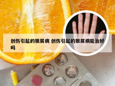 创伤引起的银屑病 创伤引起的银屑病能治好吗