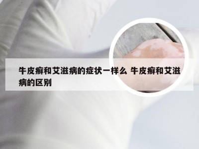 牛皮癣和艾滋病的症状一样么 牛皮癣和艾滋病的区别
