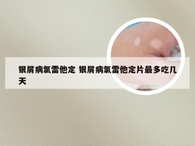 银屑病氯雷他定 银屑病氯雷他定片最多吃几天