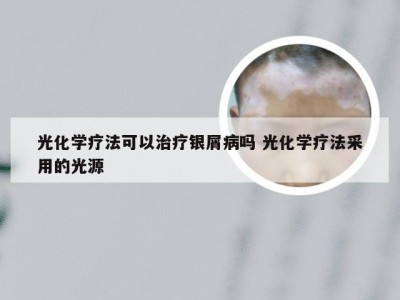 光化学疗法可以治疗银屑病吗 光化学疗法采用的光源