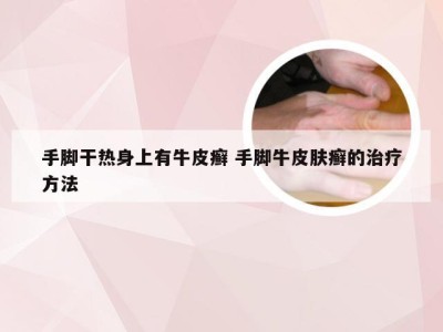 手脚干热身上有牛皮癣 手脚牛皮肤癣的治疗方法