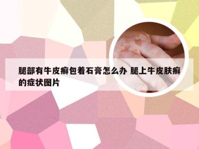 腿部有牛皮癣包着石膏怎么办 腿上牛皮肤癣的症状图片