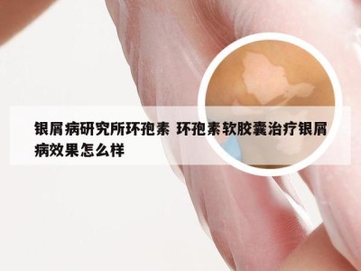 银屑病研究所环孢素 环孢素软胶囊治疗银屑病效果怎么样