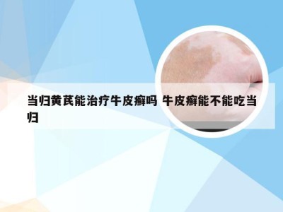当归黄芪能治疗牛皮癣吗 牛皮癣能不能吃当归