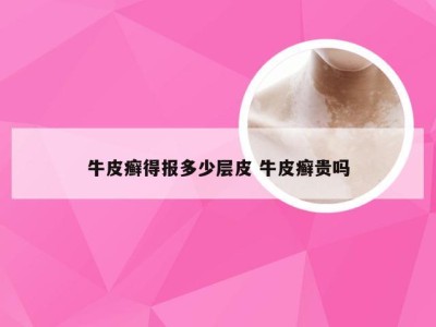 牛皮癣得报多少层皮 牛皮癣贵吗