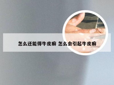 怎么还能得牛皮癣 怎么会引起牛皮癣