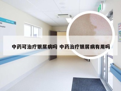 中药可治疗银屑病吗 中药治疗银屑病有用吗