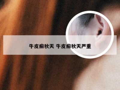 牛皮癣秋天 牛皮癣秋天严重