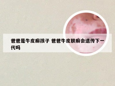 爸爸是牛皮癣孩子 爸爸牛皮肤癣会遗传下一代吗