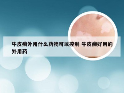 牛皮癣外用什么药物可以控制 牛皮癣好用的外用药