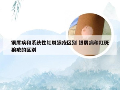 银屑病和系统性红斑狼疮区别 银屑病和红斑狼疮的区别