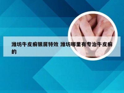 潍坊牛皮癣银屑特效 潍坊哪里有专治牛皮癣的