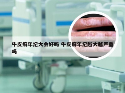 牛皮癣年纪大会好吗 牛皮癣年纪越大越严重吗
