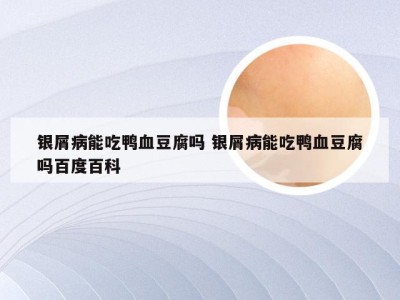 银屑病能吃鸭血豆腐吗 银屑病能吃鸭血豆腐吗百度百科