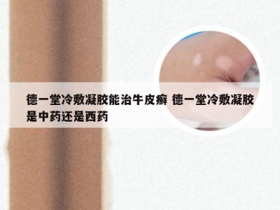 德一堂冷敷凝胶能治牛皮癣 德一堂冷敷凝胶是中药还是西药