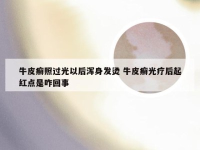 牛皮癣照过光以后浑身发烫 牛皮癣光疗后起红点是咋回事