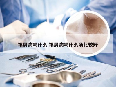 银屑病喝什么 银屑病喝什么汤比较好