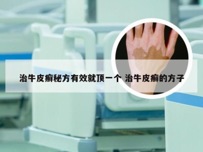 治牛皮癣秘方有效就顶一个 治牛皮癣的方子