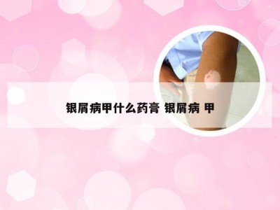 银屑病甲什么药膏 银屑病 甲