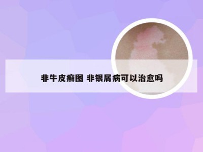 非牛皮癣图 非银屑病可以治愈吗