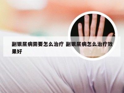 副银屑病需要怎么治疗 副银屑病怎么治疗效果好
