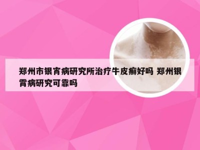 郑州市银宵病研究所治疗牛皮癣好吗 郑州银霄病研究可靠吗