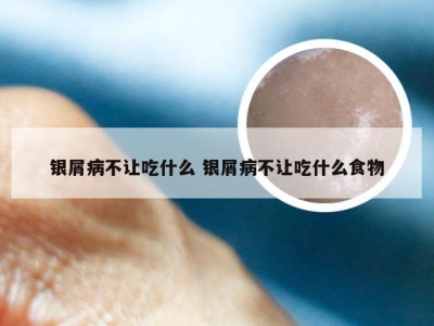 银屑病不让吃什么 银屑病不让吃什么食物