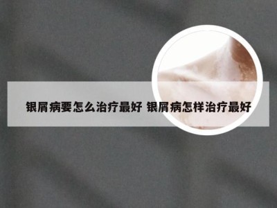 银屑病要怎么治疗最好 银屑病怎样治疗最好