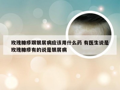 玫瑰糠疹跟银屑病应该用什么药 有医生说是玫瑰糠疹有的说是银屑病