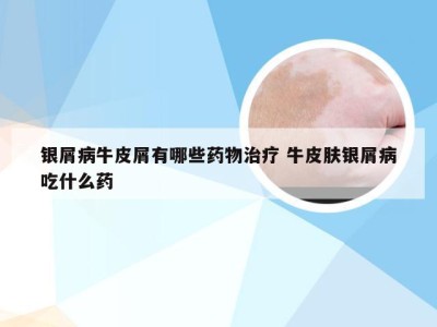 银屑病牛皮屑有哪些药物治疗 牛皮肤银屑病吃什么药