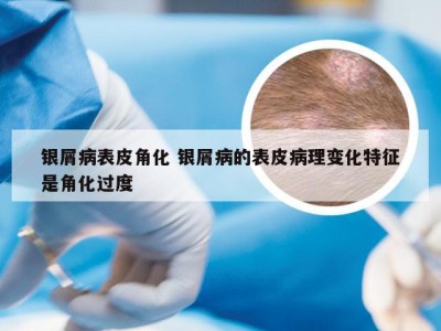 银屑病表皮角化 银屑病的表皮病理变化特征是角化过度