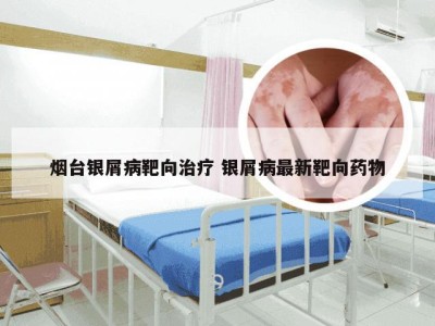 烟台银屑病靶向治疗 银屑病最新靶向药物
