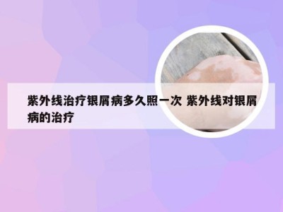 紫外线治疗银屑病多久照一次 紫外线对银屑病的治疗