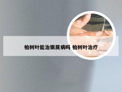 柏树叶能治银屑病吗 柏树叶治疗