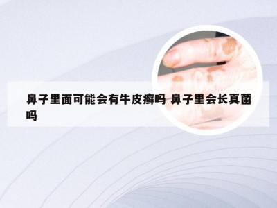 鼻子里面可能会有牛皮癣吗 鼻子里会长真菌吗