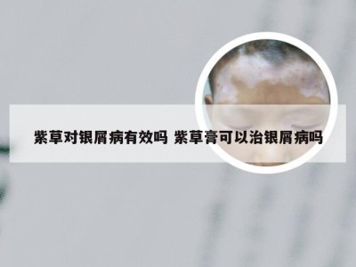 紫草对银屑病有效吗 紫草膏可以治银屑病吗