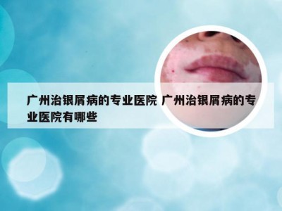 广州治银屑病的专业医院 广州治银屑病的专业医院有哪些