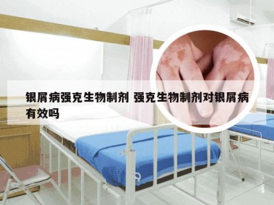 银屑病强克生物制剂 强克生物制剂对银屑病有效吗