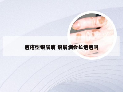 痘疮型银屑病 银屑病会长痘痘吗