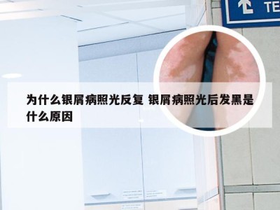 为什么银屑病照光反复 银屑病照光后发黑是什么原因