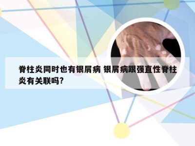 脊柱炎同时也有银屑病 银屑病跟强直性脊柱炎有关联吗?