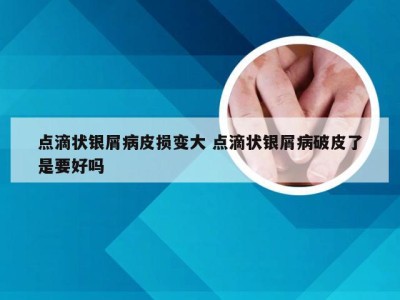 点滴状银屑病皮损变大 点滴状银屑病破皮了是要好吗