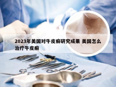 2023年美国对牛皮癣研究成果 美国怎么治疗牛皮癣