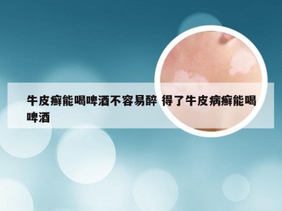 牛皮癣能喝啤酒不容易醉 得了牛皮病癣能喝啤酒