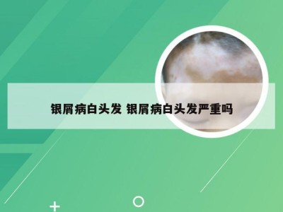 银屑病白头发 银屑病白头发严重吗