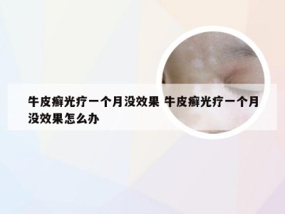 牛皮癣光疗一个月没效果 牛皮癣光疗一个月没效果怎么办