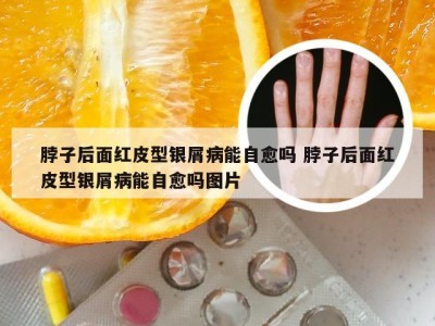脖子后面红皮型银屑病能自愈吗 脖子后面红皮型银屑病能自愈吗图片