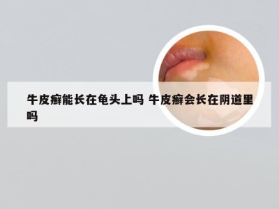 牛皮癣能长在龟头上吗 牛皮癣会长在阴道里吗